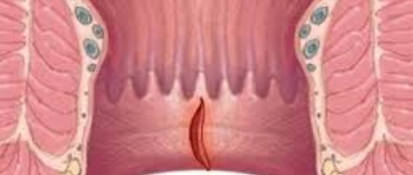 Bleeding Per Anus And Only Free Treatment