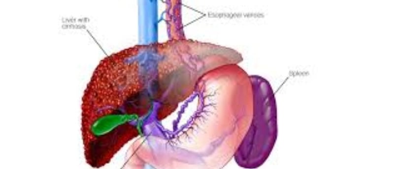 Esophageal Varices: A Comprehensive Guide to Managements