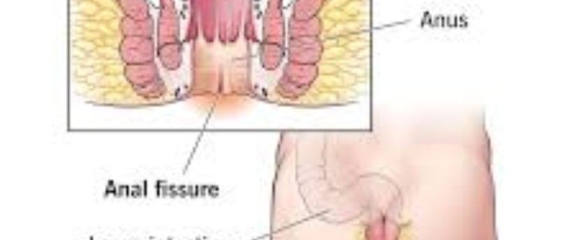 FAQs Natural Remedies for Anal Fissures and Fistulas Start with Honey and Fasting