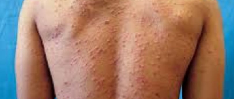 Fasting For Skin Allergies Itching & Pruritus