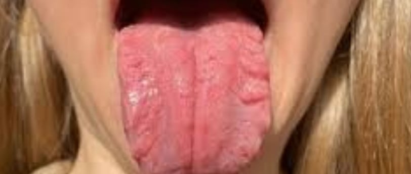 FISSURED TONGUE