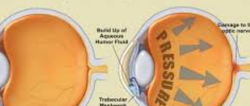 Glaucoma : Treatment alternative