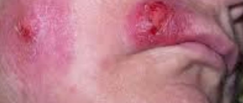 Multiple Body Abscesses Fasting and Honey