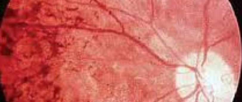 retinitis pigmentosa