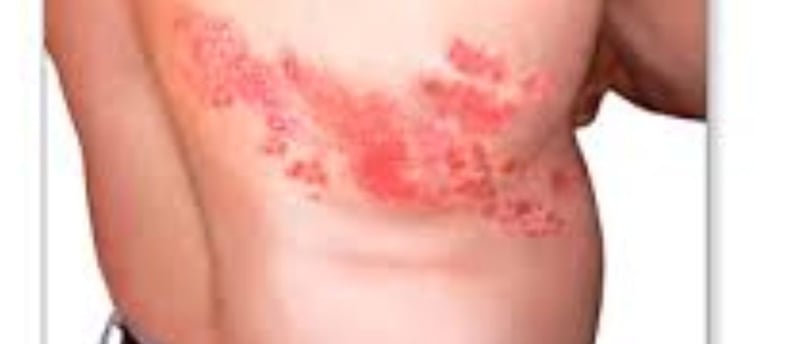 Shingles (Herpes Zoster) Ring of Fire : traditional vs strange treatment