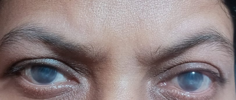 severe-dry-eyes-scleral-lens