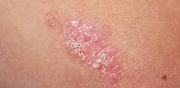 psoriasis meaning in urdu