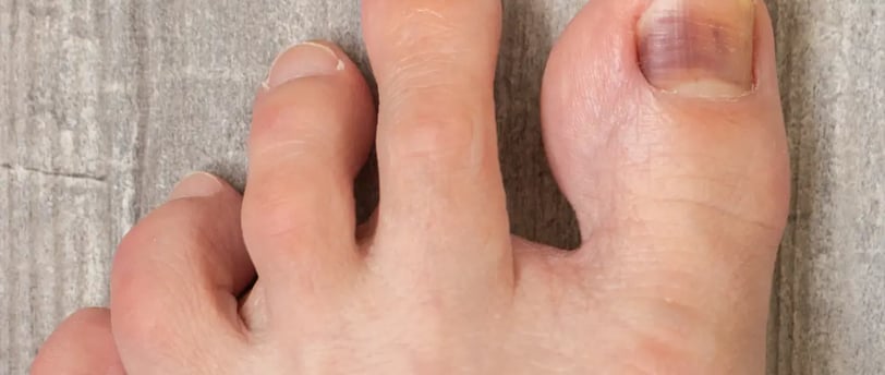 ногтевой грибок на ногтевой пластине на ноге