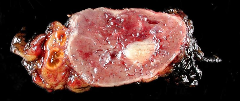 Pheochromocytoma