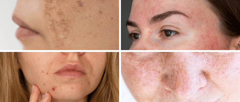 a woman with freckered skin Melasma, high cortisol, acne, hyperpigmentation