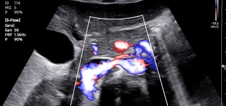 Artéria Renal Direita no Doppler em paciente sem patologias.