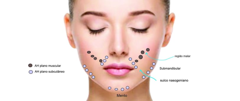 Cartografia facial com depósitos de Ácido Hialurônico