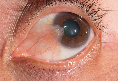pterígio, pterigio, cirurgia de pterigio, imagem mostrando pterigio, carne crescida nos olhos, são paulo