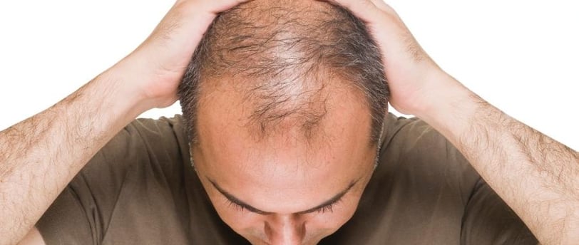 Quais os Melhores Suplementos para Queda de Cabelo