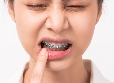dolor con brackets