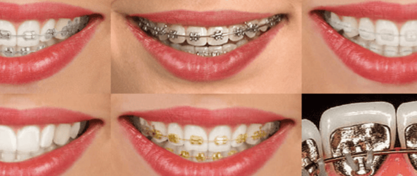 tipos de brackets