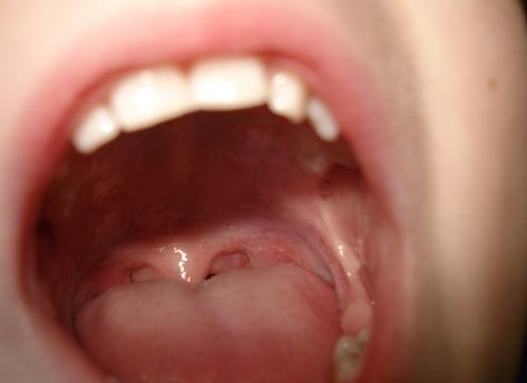 cancer bucal