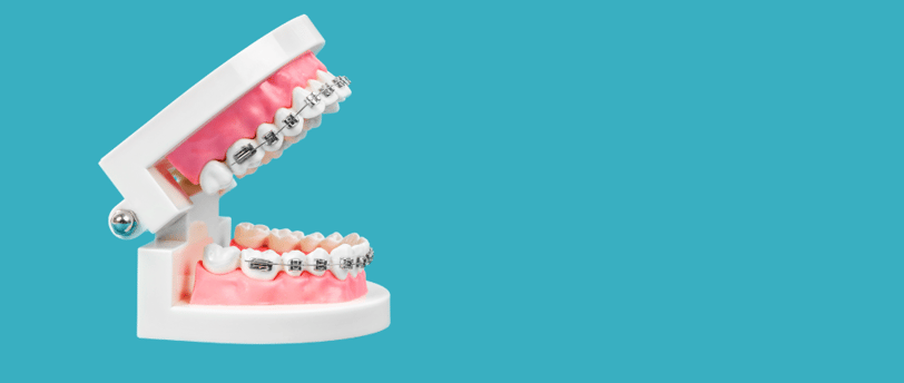 crooked teeth in adults - understanding your options