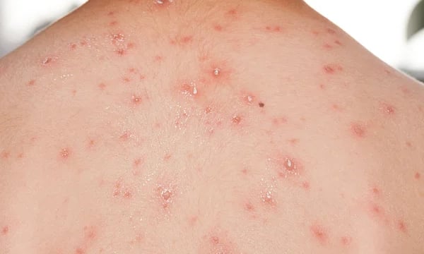 Chickenpox