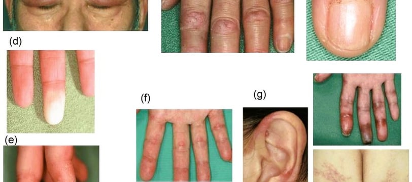 Interstitial Lung Disease: