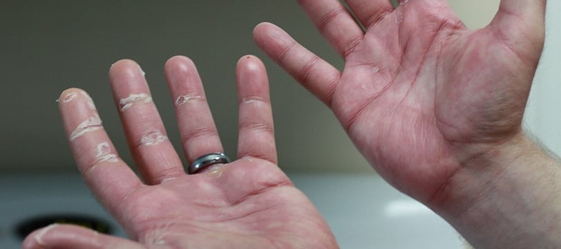 Palmar Erythrodysesthesia