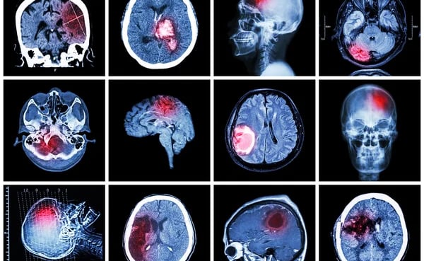 Brain tumor
