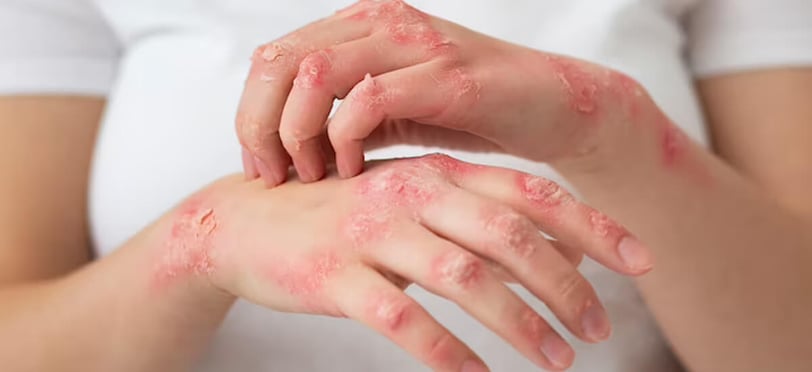 Herpes: