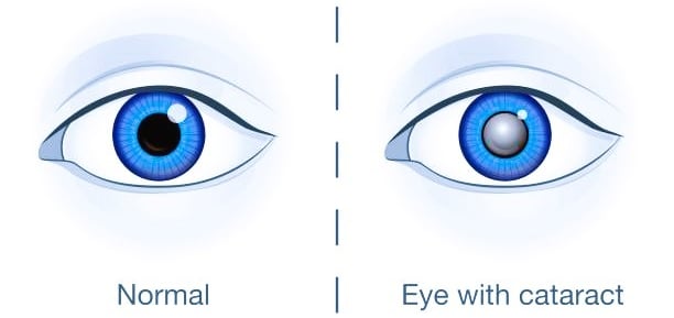 cataracts