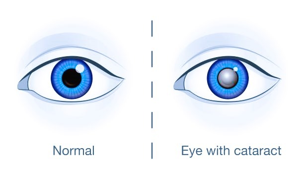 cataracts