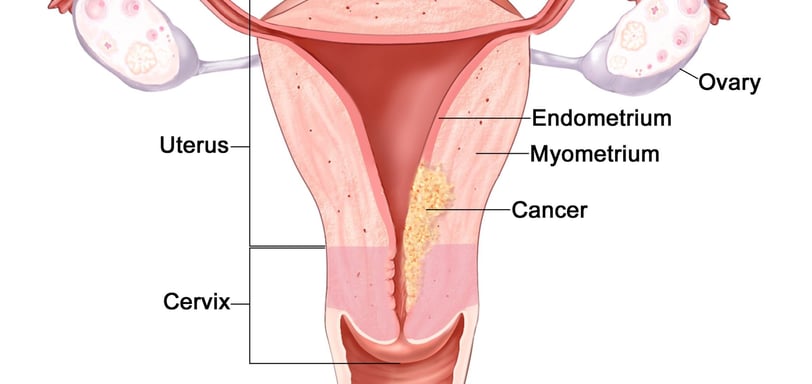 Endometrial cancer