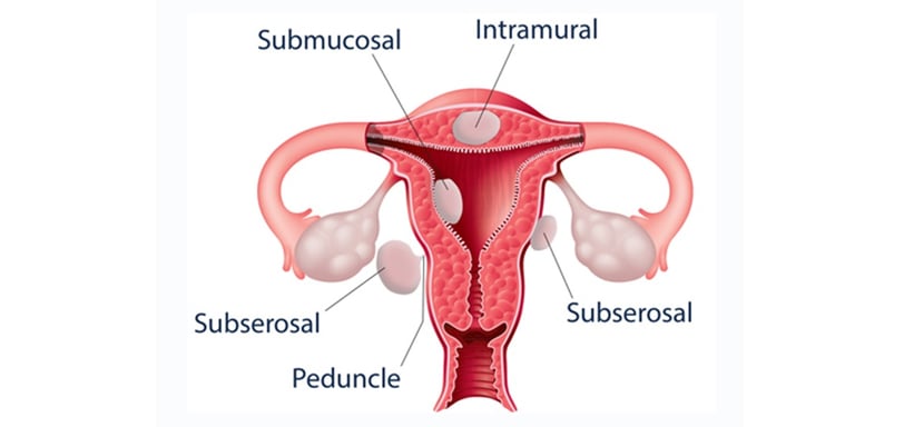 Uterine fibroids