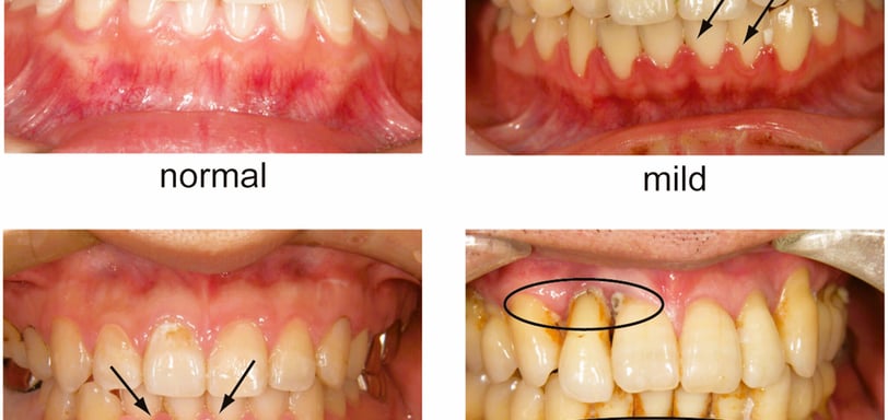 periodontal