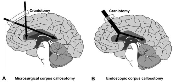 corpus callosotomy epilepsy treatment illustration