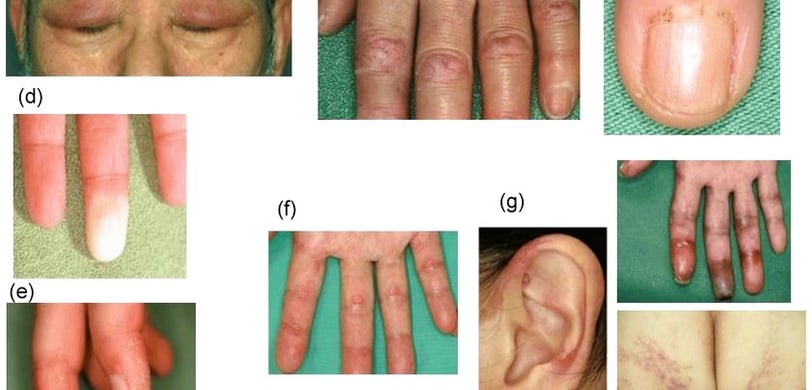 lung disease