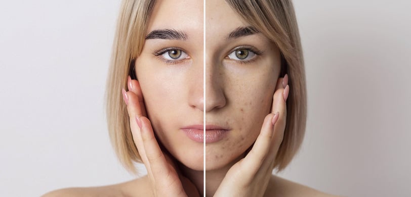azelaic acid for acne breakouts