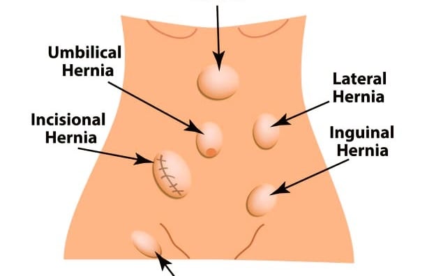 Hernias