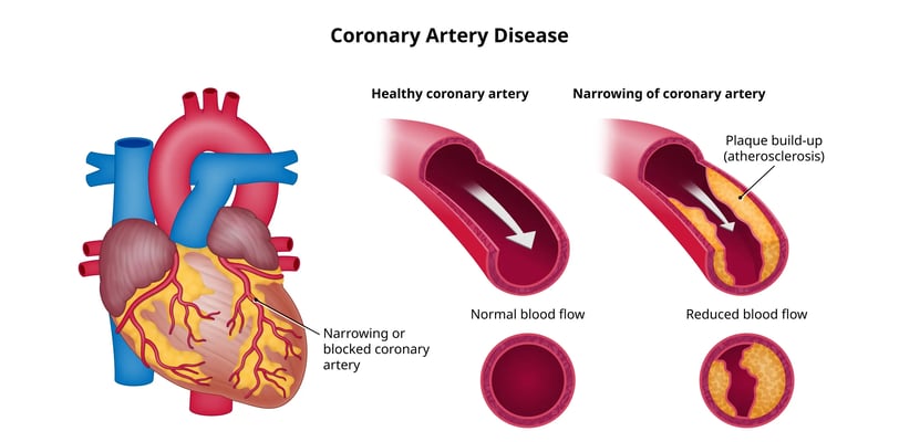 coronary artery disease