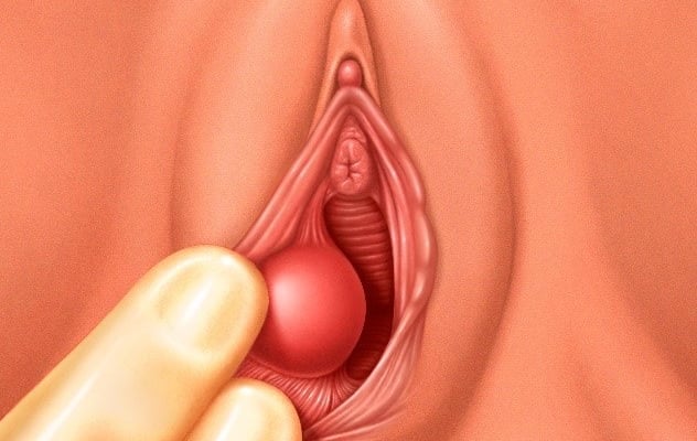 Bartholin Cysts