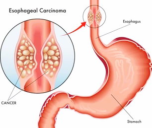 esophageal cancer
