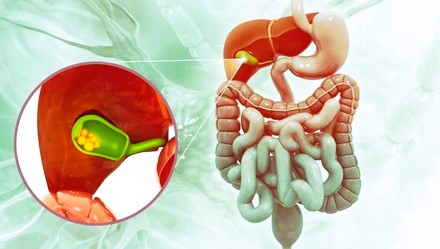 gallstones
