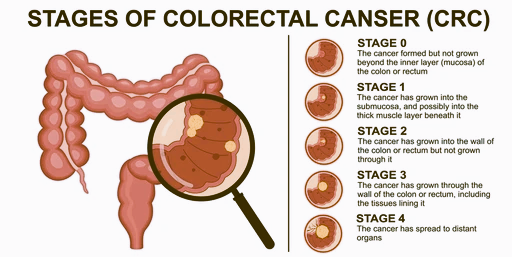 colorectal cancer