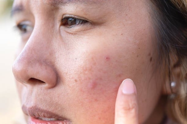 Reduce inflammation