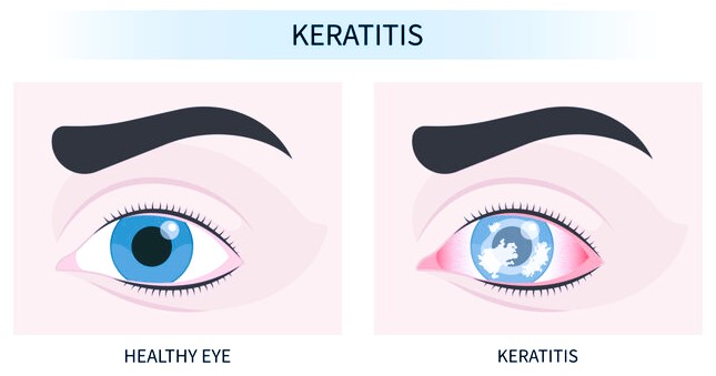 keratitis