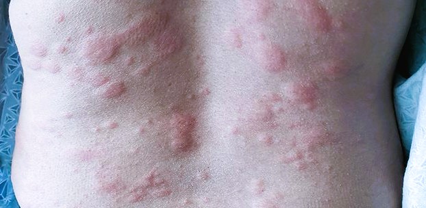 Hives