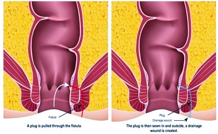 Anal Fistula