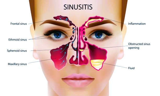 Sinusitis image