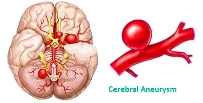 cerebral aneurysm