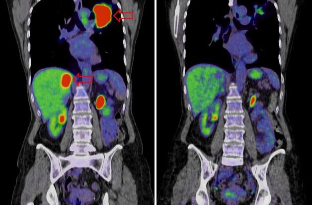 liver cancer