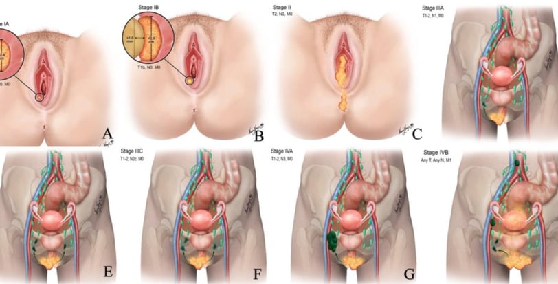 vulvar cancer