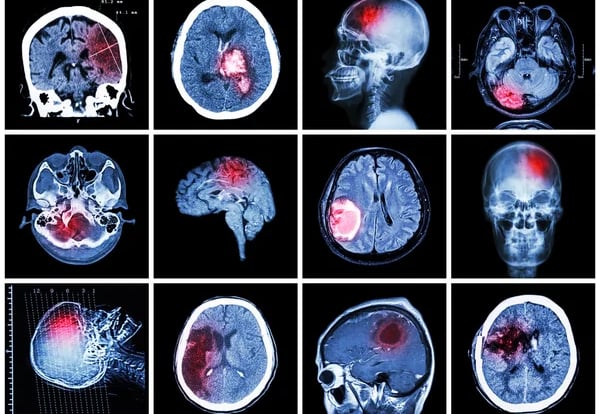 Brain Tumors